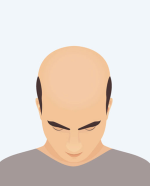 Difúzne po celej hlave